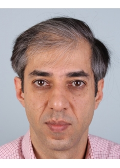 Before Hair Transplant&nbsp;2 Sessions (Areas)